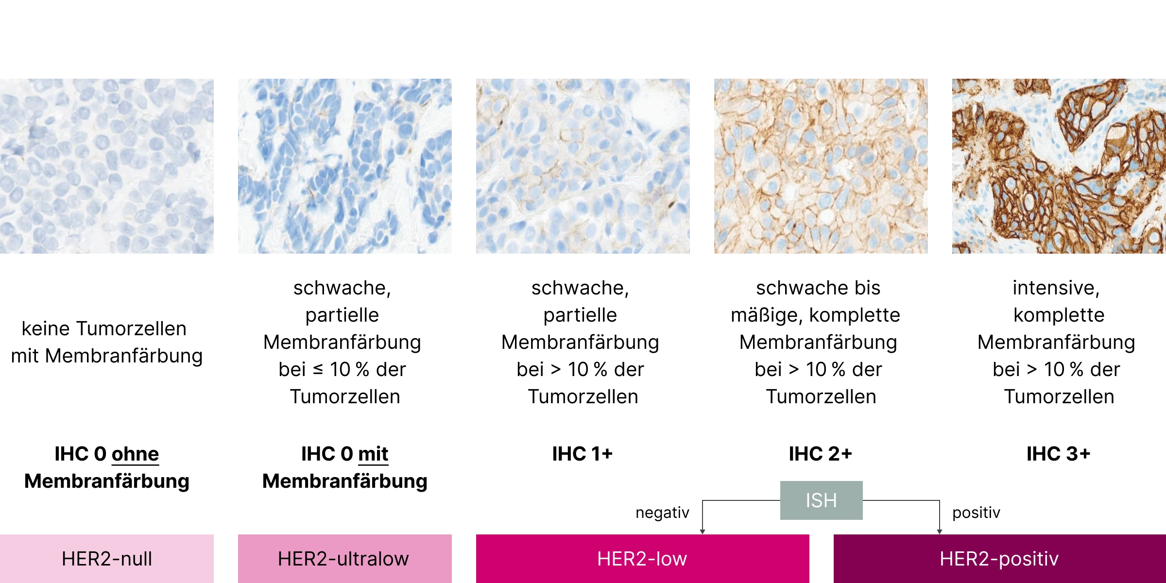 1.3.2-03-tumorerkrankungen-HER2-Mamma-grafik-evaluation2x.webp